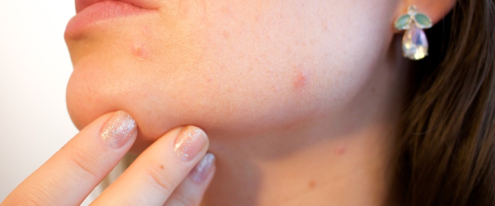 Common Acne Treatments That You Should Know